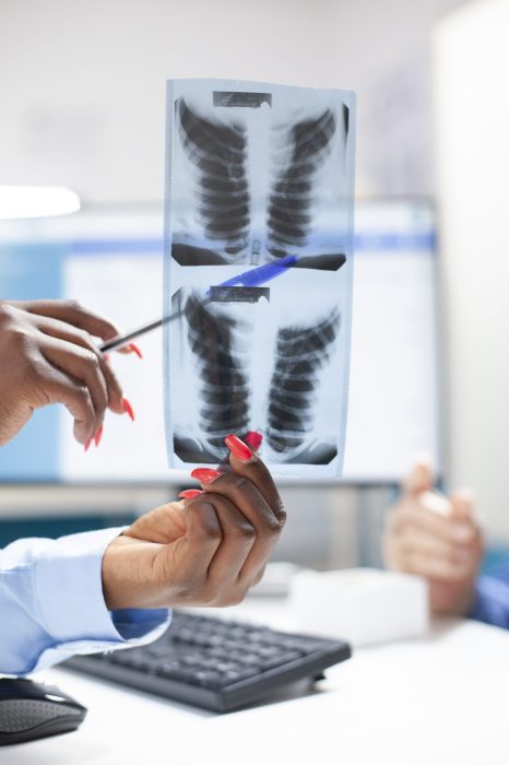 Physian uses xray to explain diagnosis Detailed view of african american physician female hand holding xray and pointing out areas for caucasian patient during clinic visit. Closeup of radiograph being used to explain diagnosis results.